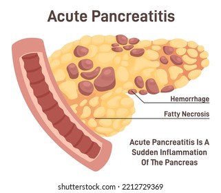 Pancreatitis Disease. Pain And Inflammation In Human Internal Organ. Anatomical Structure Of Pancreas. Abdominal Pain Cause. Flat Vector Illustration