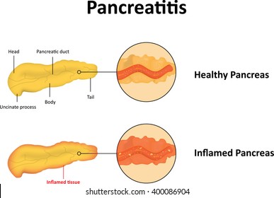 Pancreatitis Illustration