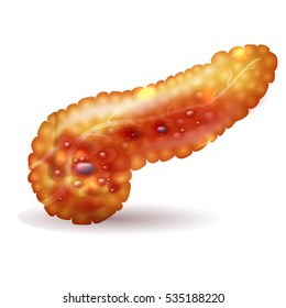 Pancreatitis illustration, inflammation of pancreas on a white background