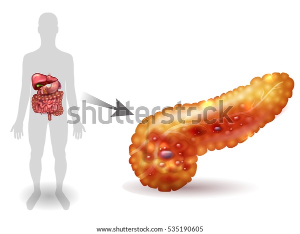 Pancreatitis Illustration Inflammation Pancreas On White Stock Vector