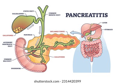 Pancreatitis as pancreas inflammation from chronic or acute gallstones outline diagram. Labeled educational medical scheme with duct anatomy and inflamed digestive tract tissue vector illustration.