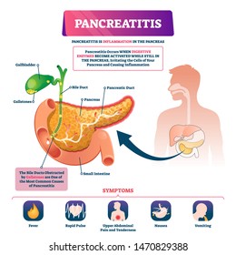 Pancreatitis vector illustration. Labeled sick pancreas inflammation scheme. Digestive enzymes irritating cells explanation diagram with symptoms list. Inner organ structure and pain disease diagnosis