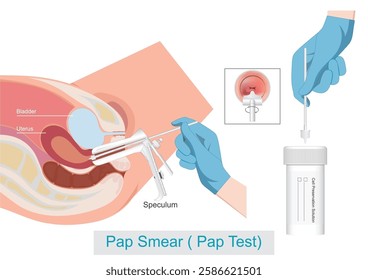 Pap Smear Cervical Cancer Screening (Pap Test) by Sampling the endocervix using the cervical brush.Thin Prep Plus Cervista HPV DNA Testing, medical healthcare, vector illustration.