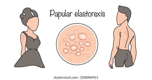 Elastorexe papular. Doença crônica com curso benigno, que se manifesta pelo aparecimento de pápulas brancas-amarelas densas principalmente na área do tronco e membros. Ilustração vetorial.