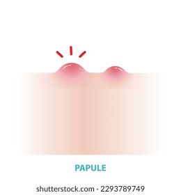 Papule acne vector isolated on white background. Formation of inflammatory acne, small, raised, solid pimple or swelling, forming on the skin and  inflamed. Flat design vector acne illustration.