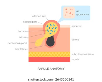 Papule anatomia plana ilustração vetorial. Infográfico médico mostrando a estrutura da pele, acúmulo de sebo, inflamação e visão superficial. Cuidados com a pele e conceito dermatológico.