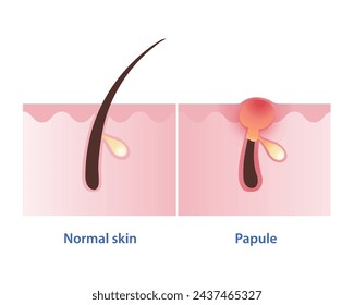 Papule, type of inflammatory acne vector isolated on white background. Cross section of normal skin and papule pimple is small, solid, red, inflamed bump in skin layer. Skin care concept illustration.