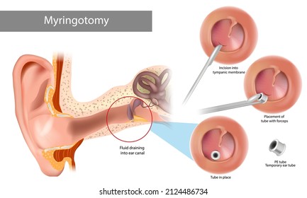 Paracentesis or myringotomy. Incision into tympanic membrane. Surgical procedure involving puncture of the tympanic membrane in order to evacuate the middle ear of pathological secretion.