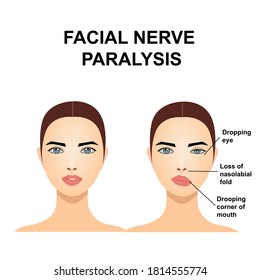 Paralysis of the facial nerve. Bell's palsy. Vector