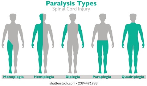 Paralysis types, spinal cord injury. Hemiplegia, diplegia, monoplegia, paraplegia, quadriplegia. causes, stroke, tumor, nerve damage brain. Face palsy. Side man human body. Medical illustration vector