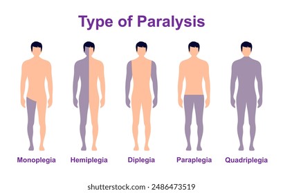 Paralysis types, spinal cord injury. Stroke, tumor, nerve damage brain. Face palsy.