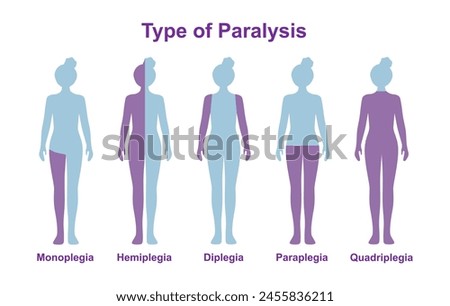 Paralysis types, spinal cord injury. Stroke, tumor, nerve damage brain. Face palsy.