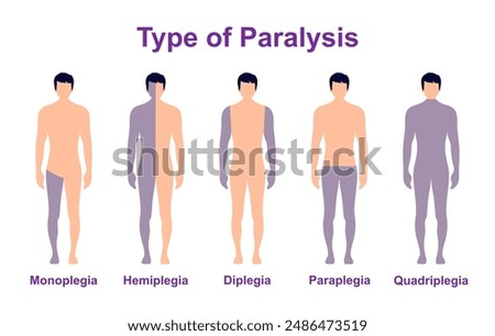Paralysis types, spinal cord injury. Stroke, tumor, nerve damage brain. Face palsy.