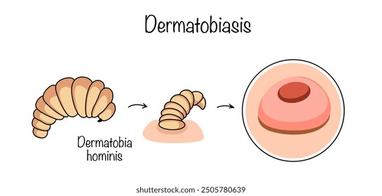 A parasitic disease of humans caused by the larva of the gadfly. The manifestation of the disease includes single or multiple skin lesions in the form of tumor-like formations. Vector illustration.