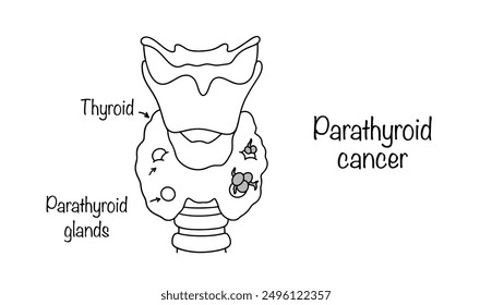 Parathyroid cancer. An oncological disease in which a malignant tumor forms in the structure of one or more parathyroid glands. Rare malignant tumor. Vector illustration.