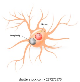 Parkinson's disease and Alzheimer's disease. large black sphere inside the body of a neuron, a Lewy Body confirms the diagnosis of parkinsonism.