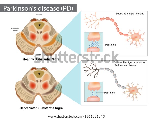 Parkinson\'s disease is characterized by the loss\
of dopaminergic neurons. Dopamine system. anatomy of the Central\
nervous system. Aging\
process