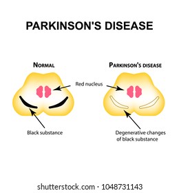 Parkinson's disease. Degenerative changes in the brain are a black substance. Vector illustration on isolated background.