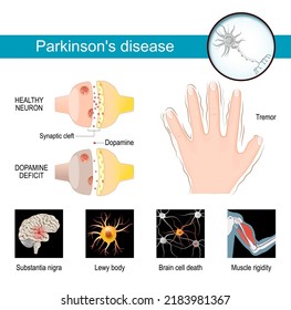 Parkinson's disease Infographic. Healthy neuron, and Synaptic cleft with dopamine deficit. Symptoms of a parkinsonism. Tremor or hands shaking. Vector poster and medical materials for your design