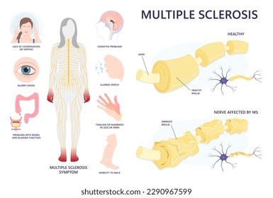 Die Anatomie des zentralen Nervensystems und der axonalen terminalen Zelldegeneration, die in der Medizin das Taubheitsgefühl der Hände oder Füße auslösen