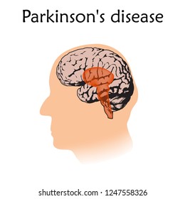 Parkinson's disease poster, banner. Vector medical illustration. White background, pink silhouette of old man head, anatomy flat image of damaged human brain.