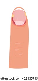 Paronychia concepnt vector for medical blog, app, banner.  Irritation or infection of finger. It can affect fingernails or toenails. Nail inflammation that may result from trauma,