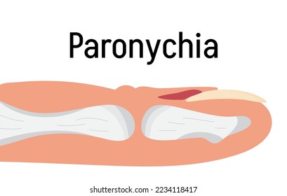 Paronychia concepnt vector for medical blog, app, banner. Nail inflammation that may result from trauma, irritation or infection. It can affect fingernails or toenails.