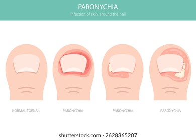 A paroníquia é uma infecção da prega ungueal que causa vermelhidão, inchaço e dor. Muitas vezes ligada a bactérias, trauma ou exposição à umidade. Design de infográfico médico. Ilustração vetorial