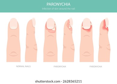 Es una infección del pliegue ungueal que causa enrojecimiento, hinchazón y dolor. A menudo se relaciona con bacterias, traumatismos o exposición a la humedad. Diseño infográfico médico. Ilustración vectorial