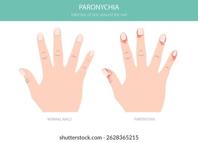 Paronychia is an infection of the nail fold causing redness, swelling, and pain. Often linked to bacteria, trauma, or moisture exposure. Medical infographic design. Vector illustration
