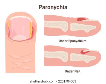 Paronychia. Nail disease, inflammation of the skin around the nail. Injured human fingernail. Flat vector illustration