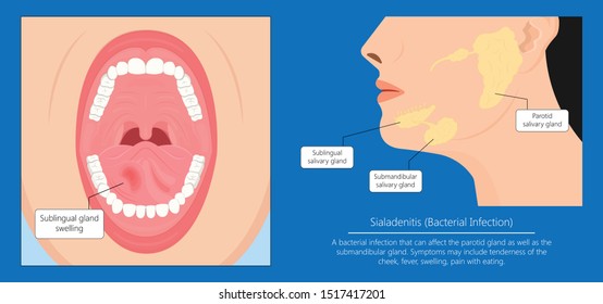 Parotid gland Sialadenitis bacterial infection Sialolithiasis blockage swelling treat Infiltrative cancer ear nose doctor calculi stones diagnose surgical examination inflammation saliva