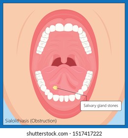 Parotid gland Sialadenitis bacterial infection Sialolithiasis blockage swelling treat Infiltrative cancer ear nose doctor calculi stones diagnose surgical examination inflammation saliva