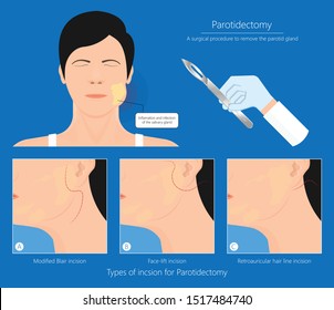 Parotid gland Sialadenitis bacterial infection Sialolithiasis blockage swelling treat Infiltrative cancer ear nose doctor calculi stones diagnose surgical examination inflammation saliva