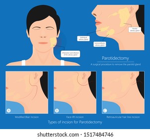 Parotid gland Sialadenitis bacterial infection Sialolithiasis blockage swelling treat Infiltrative cancer ear nose doctor calculi stones diagnose surgical examination inflammation saliva