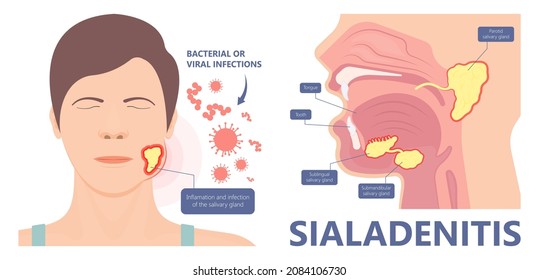 Parotid gland Sialadenitis bacterial infection Sialolithiasis blockage swelling treat Infiltrative cancer ear nose doctor calculi stones diagnose surgical examination inflammation saliva