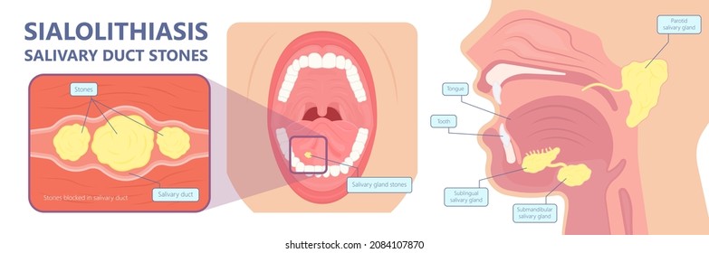 Parotid gland Sialadenitis bacterial infection Sialolithiasis blockage swelling treat Infiltrative cancer ear nose doctor calculi stones diagnose surgical examination inflammation saliva