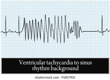 Paroxysm Of Ventricular Tachycardia In Sinus Rhythm Background. Vector. Professional Information