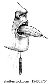 Partial Amputation of the Tongue using Ligatures, vintage engraved illustration. Usual Medicine Dictionary by Dr Labarthe - 1885