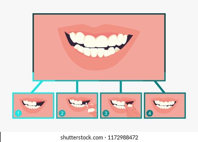 Partial denture dental. Stages of treatment. Vector flat stomatology infographics isolated on a white background.
