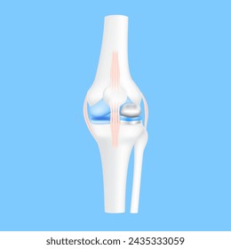 La cirugía de reemplazo parcial de rodilla o el implante para el tratamiento alivian la artritis, después de la lesión articular. Hueso de la pierna y ligamento del cartílago. Tratamiento de tecnología médica de innovación. Vector realista 3D EPS10.