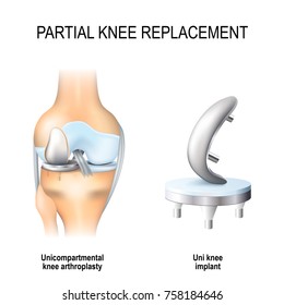 Partial Knee Replacement. Unicompartmental Knee Arthroplasty And Uni Knee Implant 