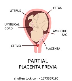 Partial Placental Location During Pregnancy. detailed medical picture with table of symbols. Pathology. Colored vector illustration isolated on white background