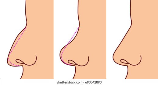 Pastic surgery performed on the nose. Before and after