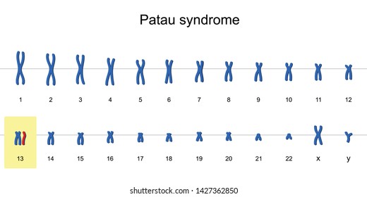Patau syndrome karyotype, Autosomal abnormalities, Trisomy 13 vector esp10