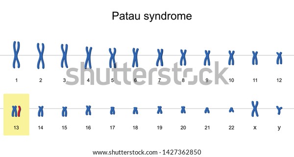 Patau Syndrome Karyotype Autosomal Abnormalities Trisomy Stock Vector ...