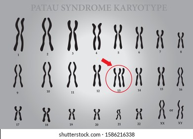 Patau syndrome karyotype is the one of chromosomal disorders that have extra copy of chromosome 13