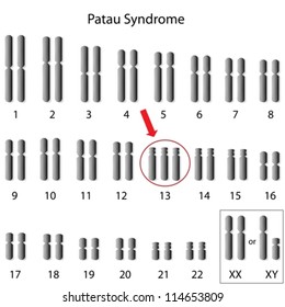 Patau Syndrome, Trisomy 13