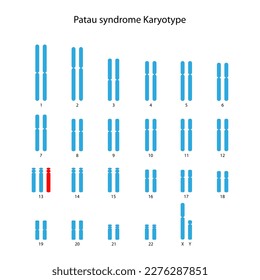 Síndrome de Patau (trisomía 13) cariotipo humano (masculino)