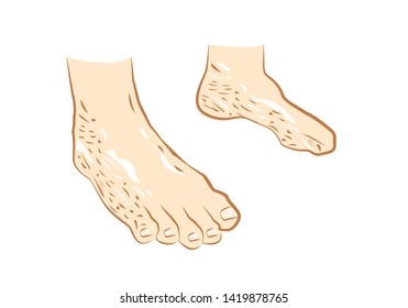 Patches Scales On Feet Caused By Stock Vector (Royalty Free) 1419878765 ...